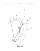 Mitral Valve Repair diagram and image