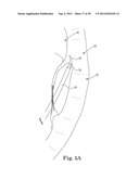 Mitral Valve Repair diagram and image