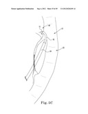 Mitral Valve Repair diagram and image