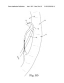 Mitral Valve Repair diagram and image