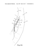 Mitral Valve Repair diagram and image