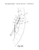 Mitral Valve Repair diagram and image