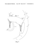 Mitral Valve Repair diagram and image