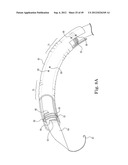 Mitral Valve Repair diagram and image