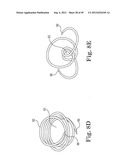 Mitral Valve Repair diagram and image