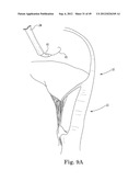 Mitral Valve Repair diagram and image