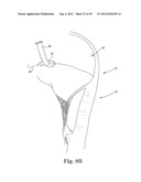 Mitral Valve Repair diagram and image