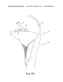 Mitral Valve Repair diagram and image