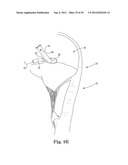 Mitral Valve Repair diagram and image