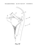 Mitral Valve Repair diagram and image