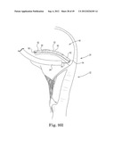 Mitral Valve Repair diagram and image