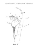 Mitral Valve Repair diagram and image