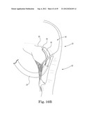 Mitral Valve Repair diagram and image