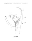 Mitral Valve Repair diagram and image