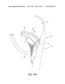 Mitral Valve Repair diagram and image