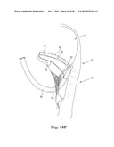 Mitral Valve Repair diagram and image