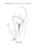 Mitral Valve Repair diagram and image