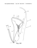 Mitral Valve Repair diagram and image