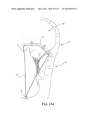 Mitral Valve Repair diagram and image