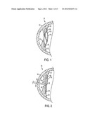 ACCOMMODATING INTRAOCULAR LENS diagram and image