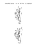 ACCOMMODATING INTRAOCULAR LENS diagram and image