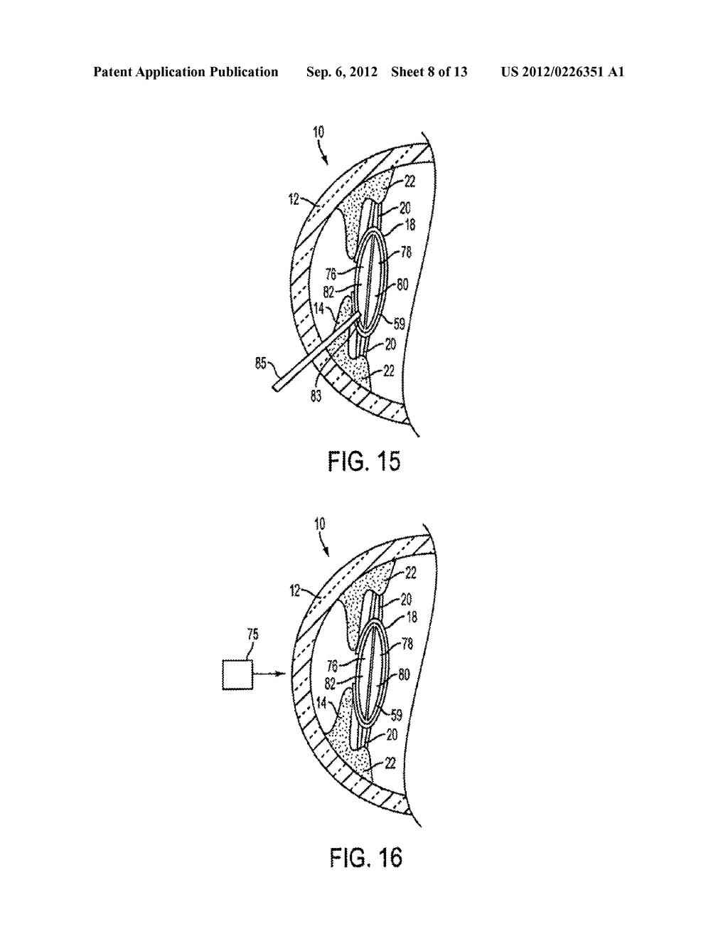 ACCOMMODATING INTRAOCULAR LENS - diagram, schematic, and image 09