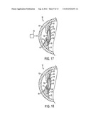 ACCOMMODATING INTRAOCULAR LENS diagram and image