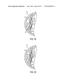 ACCOMMODATING INTRAOCULAR LENS diagram and image