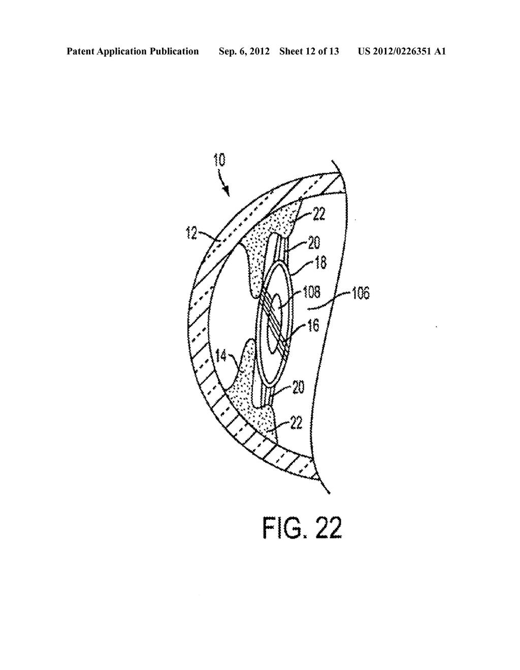 ACCOMMODATING INTRAOCULAR LENS - diagram, schematic, and image 13