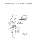 SHIELDED PROSTHETIC COMPONENT diagram and image