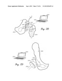 SHIELDED PROSTHETIC COMPONENT diagram and image