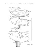 SHIELDED PROSTHETIC COMPONENT diagram and image