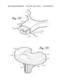 SHIELDED PROSTHETIC COMPONENT diagram and image