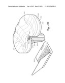 SHIELDED PROSTHETIC COMPONENT diagram and image