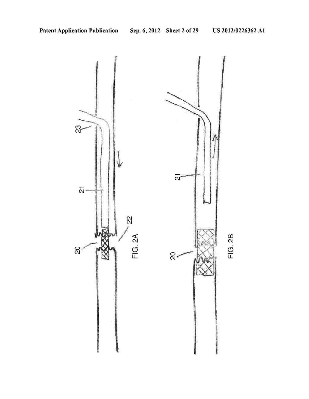 METHOD AND DEVICES FOR THE TREATMENT OF BONE FRACTURES - diagram, schematic, and image 03