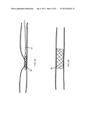 METHOD AND DEVICES FOR THE TREATMENT OF BONE FRACTURES diagram and image