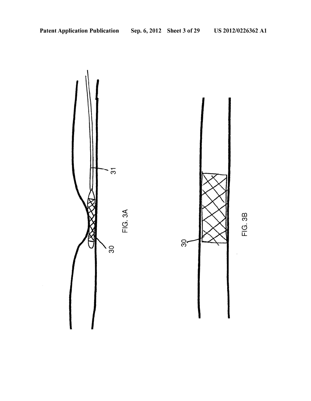 METHOD AND DEVICES FOR THE TREATMENT OF BONE FRACTURES - diagram, schematic, and image 04