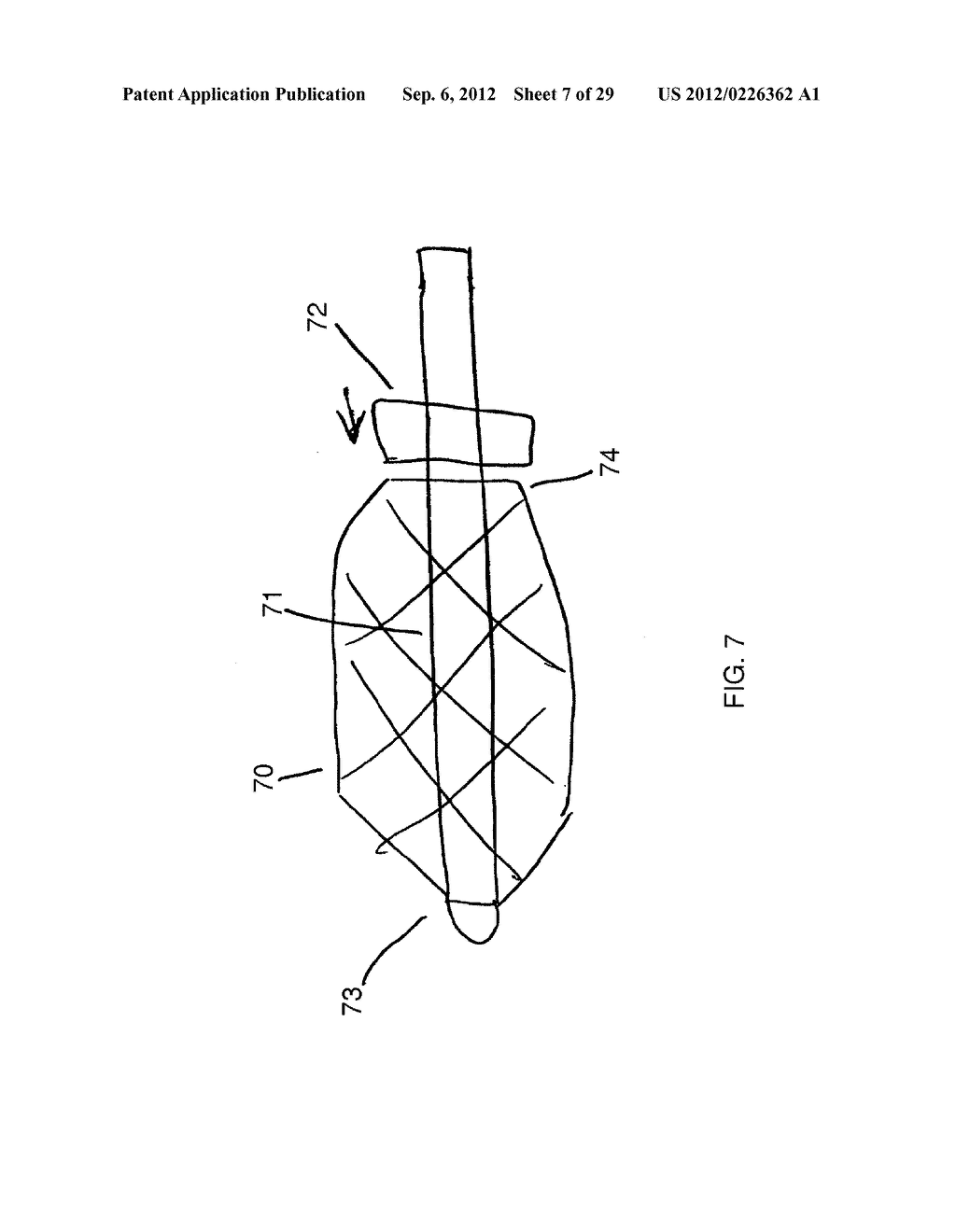 METHOD AND DEVICES FOR THE TREATMENT OF BONE FRACTURES - diagram, schematic, and image 08