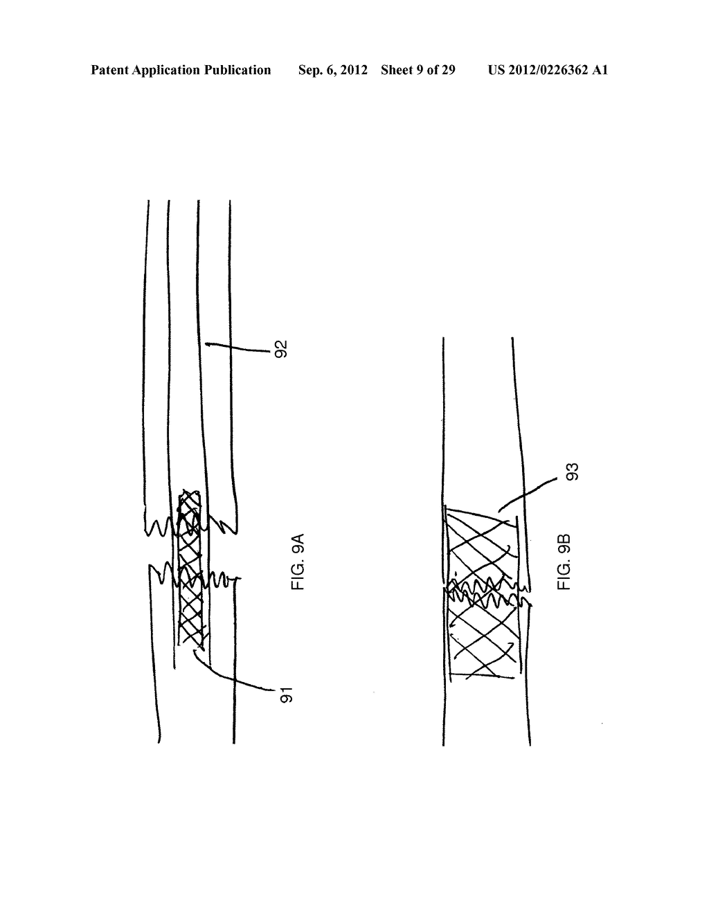 METHOD AND DEVICES FOR THE TREATMENT OF BONE FRACTURES - diagram, schematic, and image 10