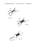 METHOD AND DEVICES FOR THE TREATMENT OF BONE FRACTURES diagram and image