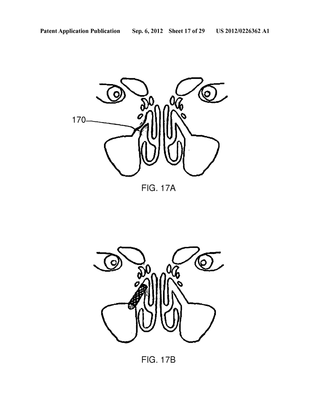 METHOD AND DEVICES FOR THE TREATMENT OF BONE FRACTURES - diagram, schematic, and image 18