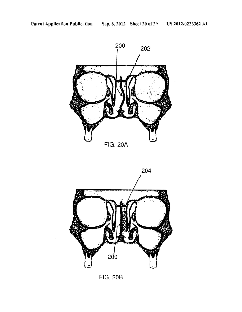 METHOD AND DEVICES FOR THE TREATMENT OF BONE FRACTURES - diagram, schematic, and image 21