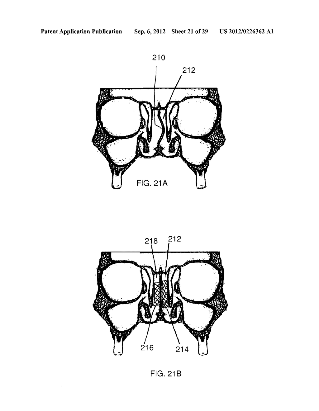 METHOD AND DEVICES FOR THE TREATMENT OF BONE FRACTURES - diagram, schematic, and image 22