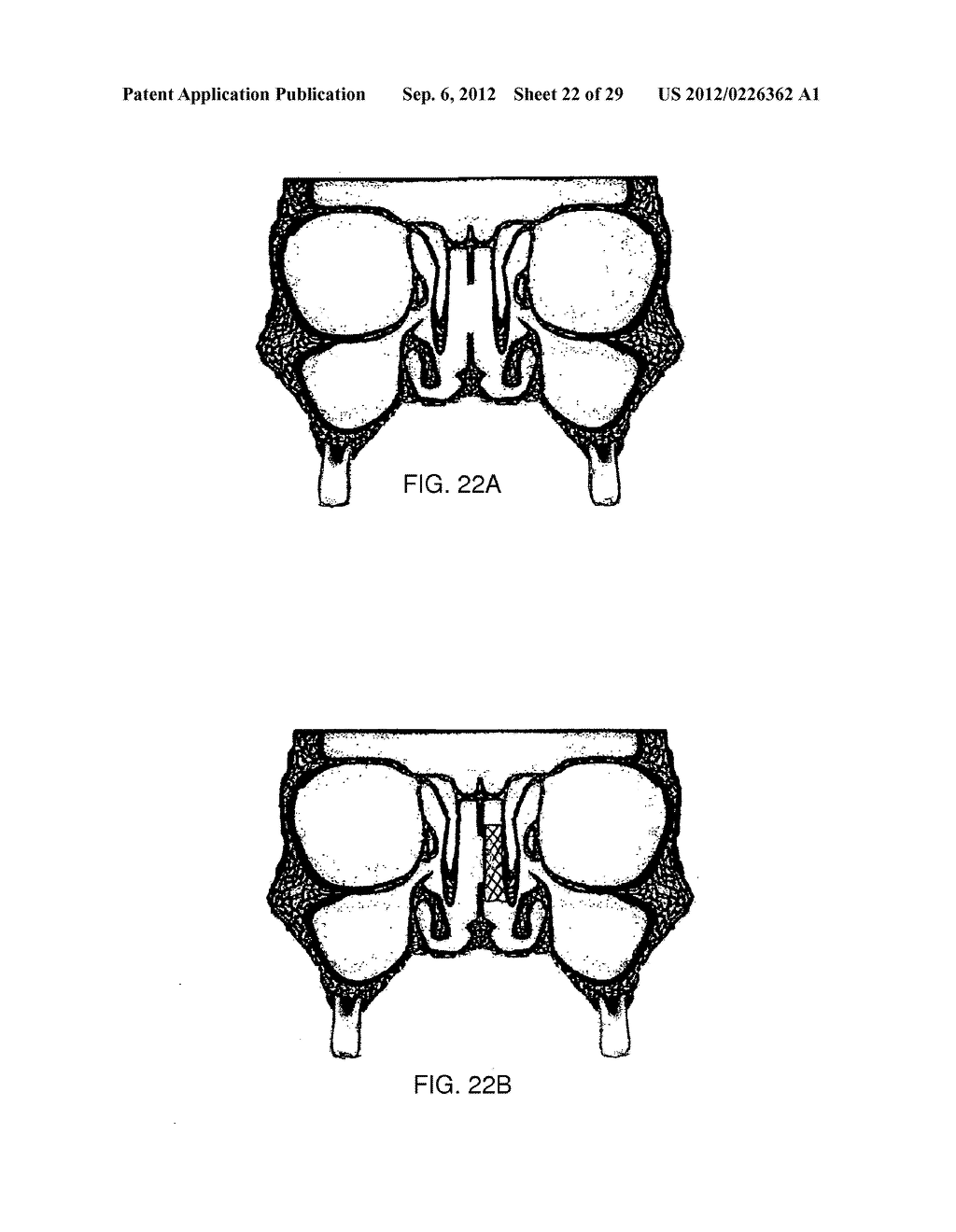 METHOD AND DEVICES FOR THE TREATMENT OF BONE FRACTURES - diagram, schematic, and image 23