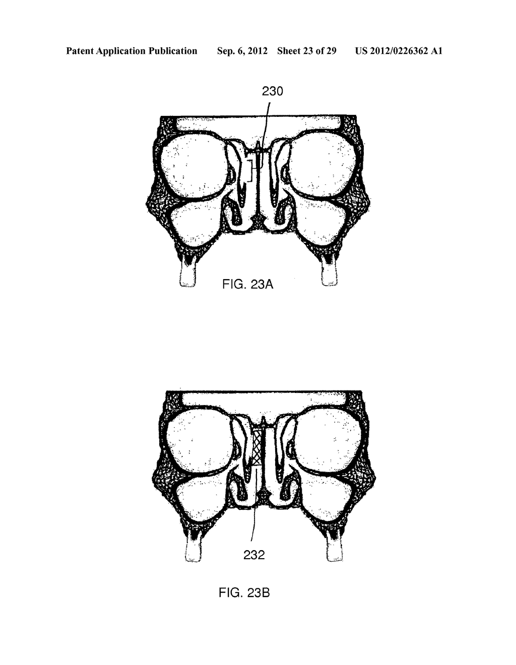 METHOD AND DEVICES FOR THE TREATMENT OF BONE FRACTURES - diagram, schematic, and image 24