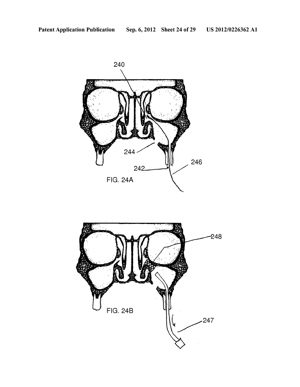 METHOD AND DEVICES FOR THE TREATMENT OF BONE FRACTURES - diagram, schematic, and image 25