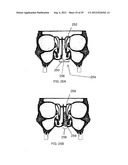 METHOD AND DEVICES FOR THE TREATMENT OF BONE FRACTURES diagram and image