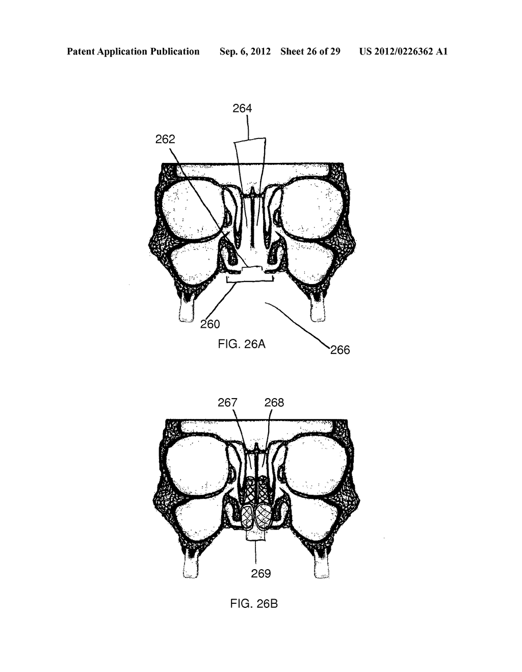 METHOD AND DEVICES FOR THE TREATMENT OF BONE FRACTURES - diagram, schematic, and image 27