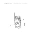 METHOD AND DEVICES FOR THE TREATMENT OF BONE FRACTURES diagram and image