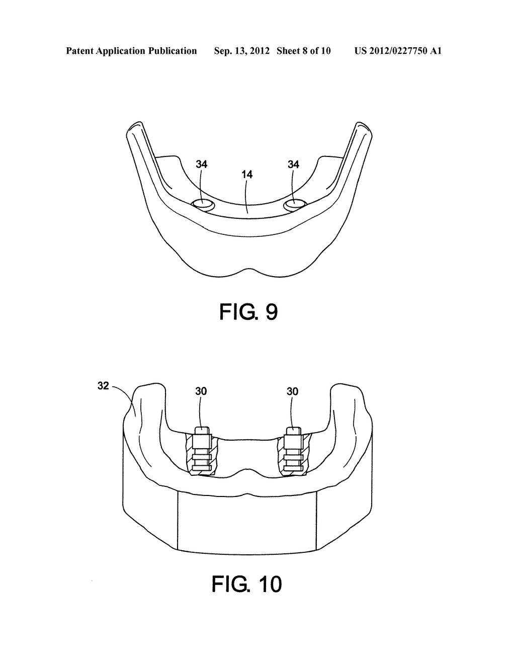 DENTAL IMPLANT FOR TREATMENT OF SLEEP APNEA - diagram, schematic, and image 09